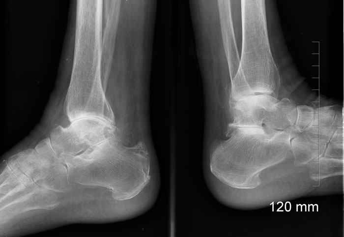 Imagerie Pathologie Arriere Pied Arthrose De L Articulation Sous Talienne